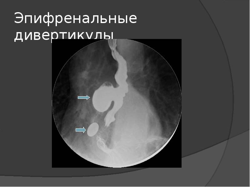 Презентация дивертикул пищевода