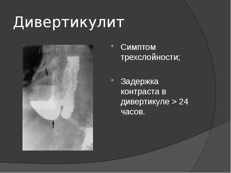 Презентация дивертикул пищевода