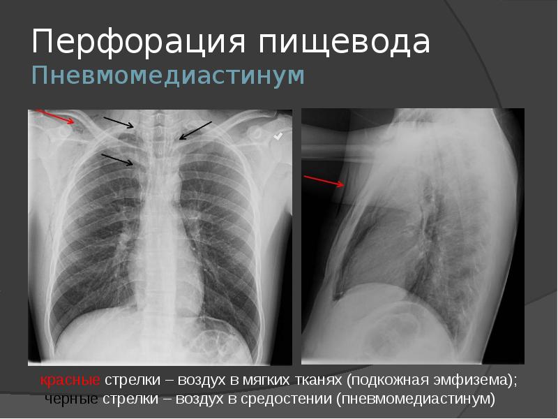 Перфорация стенки пищевода