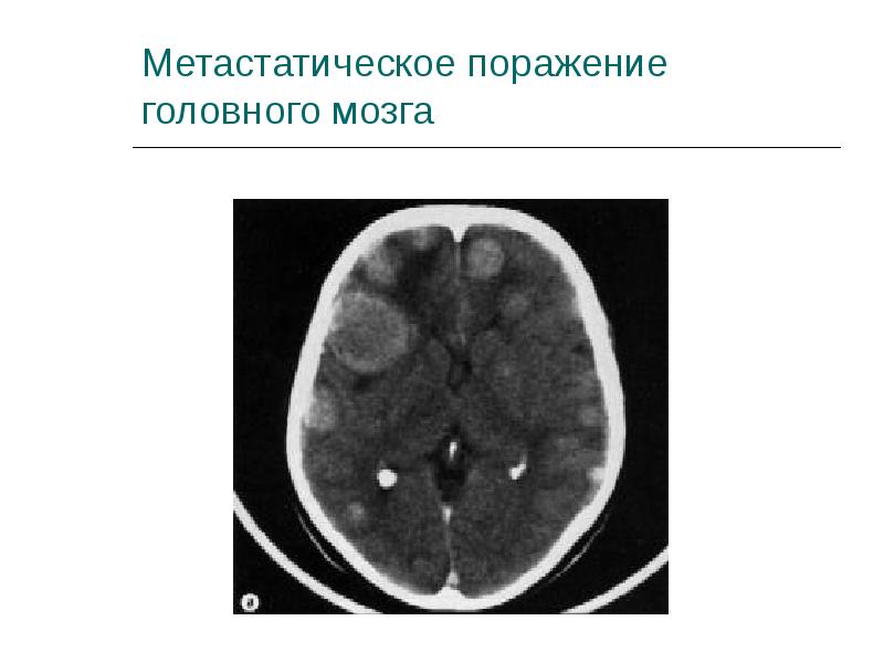 Метастазы в мозгу форум. Метастатические опухоли головного мозга. Метастатическое поражение головного мозга. Метастазы головного мозга кт. Метастатическое поражение головного мозга мрт.