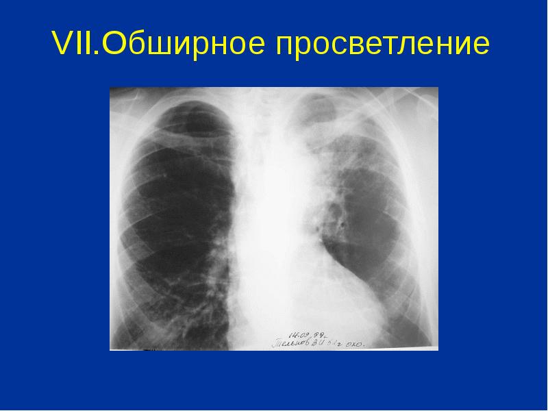 Просветление в легких. Обширное просветление легочного поля. Синдром обширного просветления легочного поля. Синдром просветления легочной ткани.