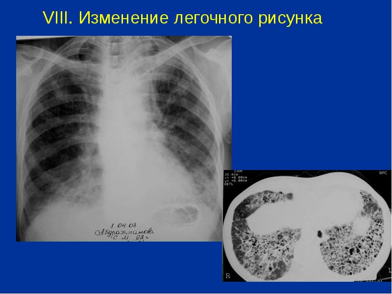 Ячеистая деформация легочного рисунка характерна для