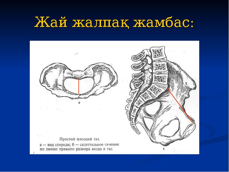 Жай жалпақ жамбас: