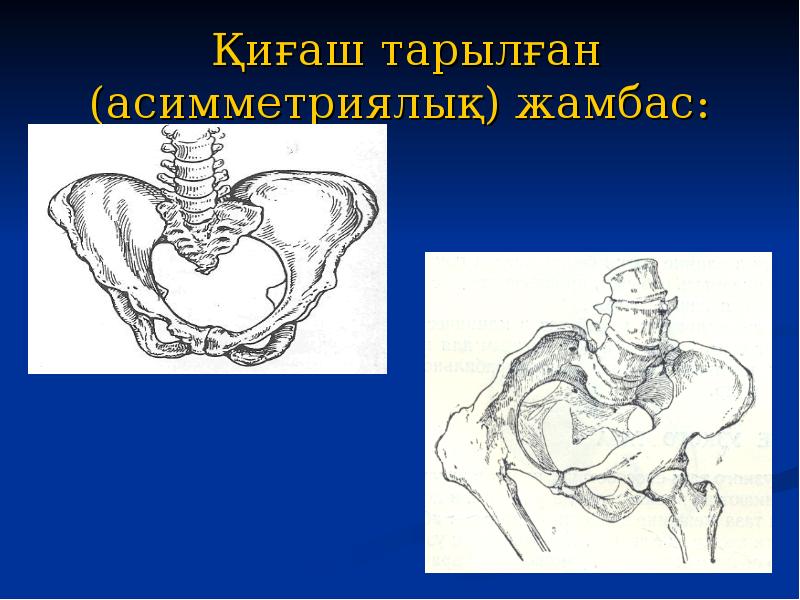 Қиғаш тарылған (асимметриялық) жамбас: