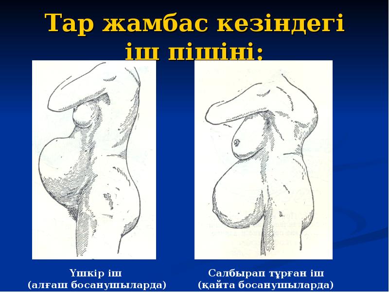 Тар жамбас кезіндегі іш пішіні: