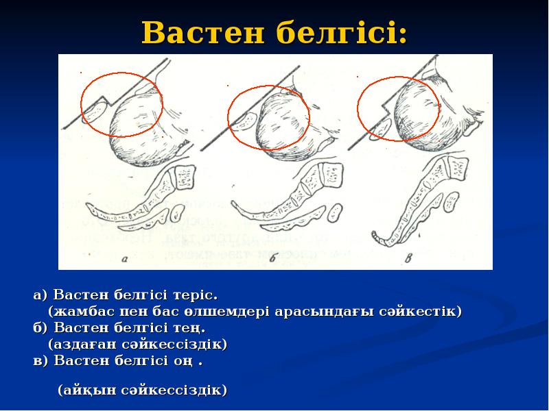 Вастен белгісі: а) Вастен белгісі теріс.   (жамбас пен бас