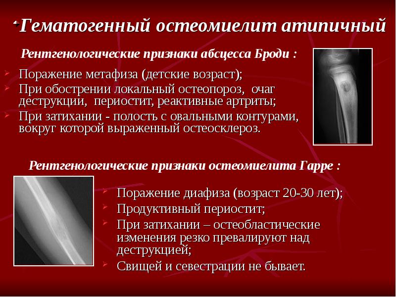 Рентгенодиагностика остеомиелита презентация