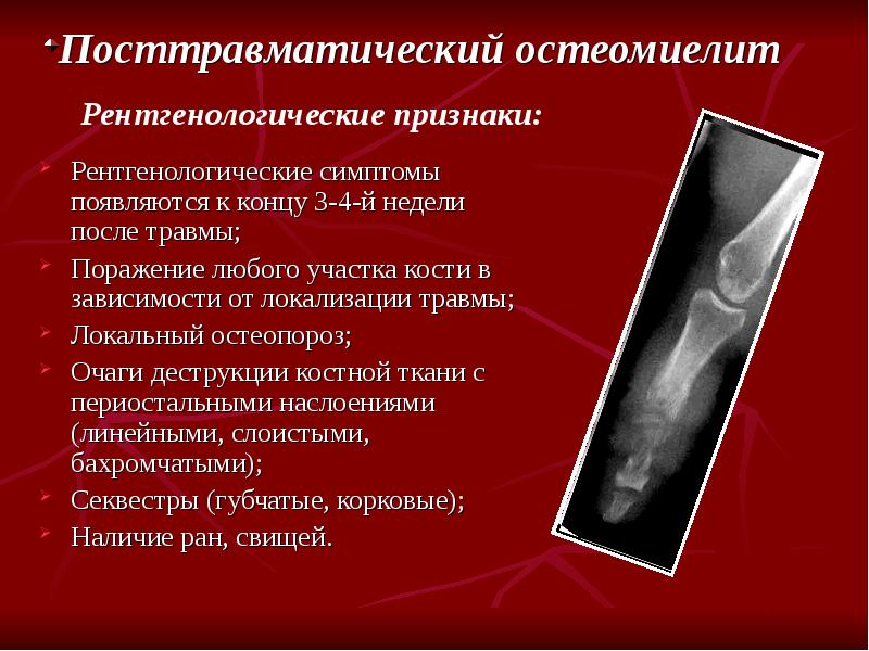 Рентгенодиагностика остеомиелита презентация