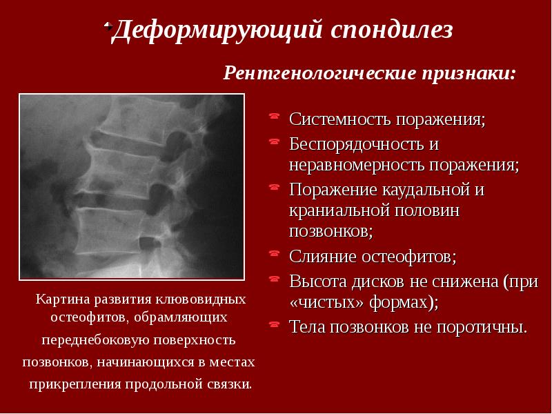 Остеохондроз шейного отдела спондилоартроз. Остеохондроз рентген описание. Деформирующий спондилоартроз рентген. Спондилоартроз стадии рентген. Остеохондроз стадии рентгенологические.