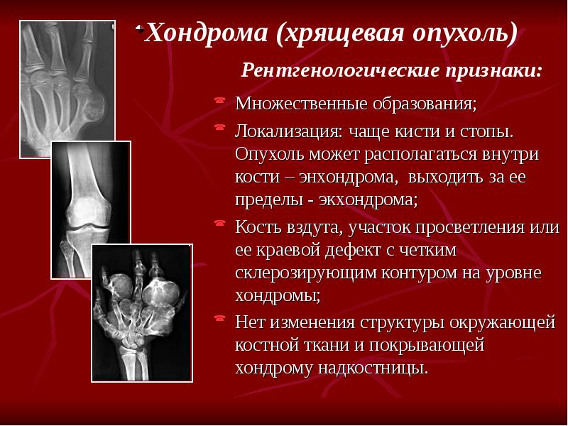 Опухоль из хрящевой ткани. Рентгенологические симптомы патологии костей и суставов. Рентгенологические симптомы поражения костей. Хондрома лучезапястного сустава. Энхондромы бедренной кости.