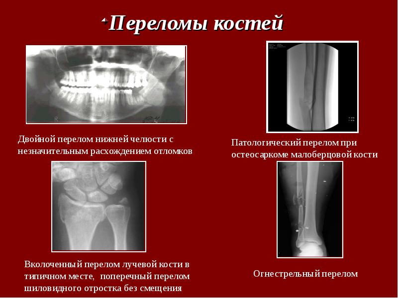 Перелом лучевой кости в типичном месте