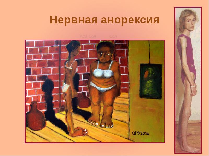 Нервная анорексия