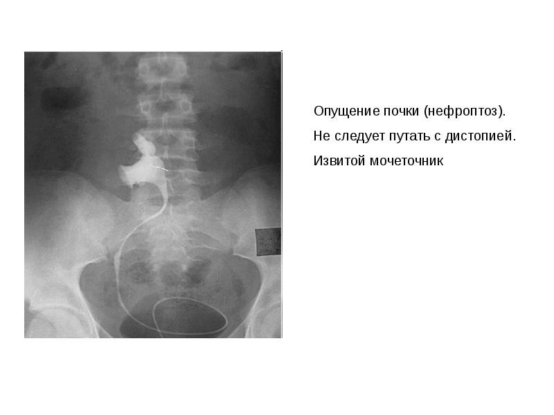 Опущение почек симптомы и последствия