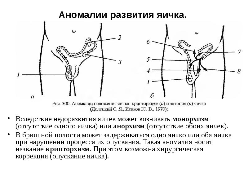 Анорхизм яичек картинка