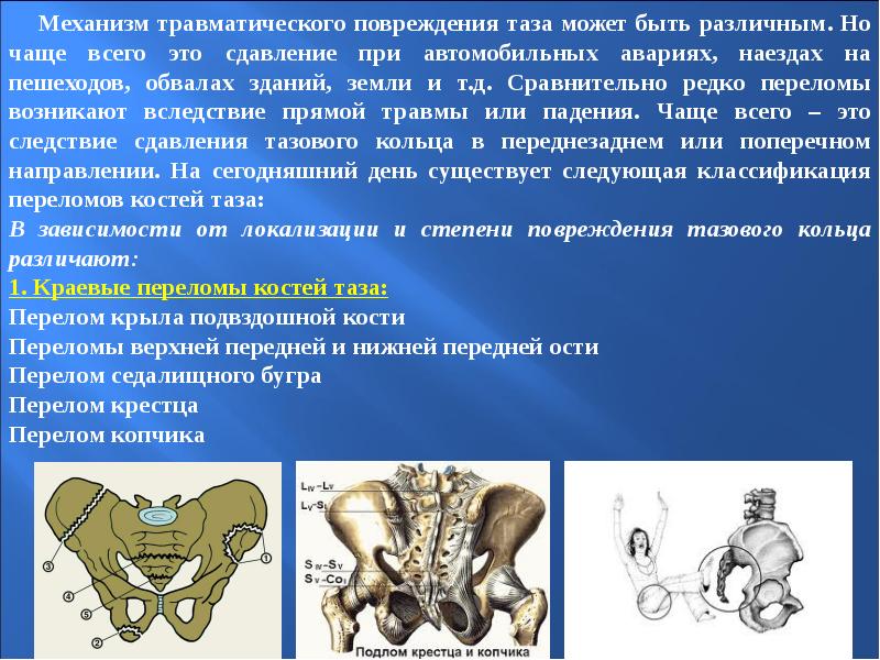 Переломы конечностей таза