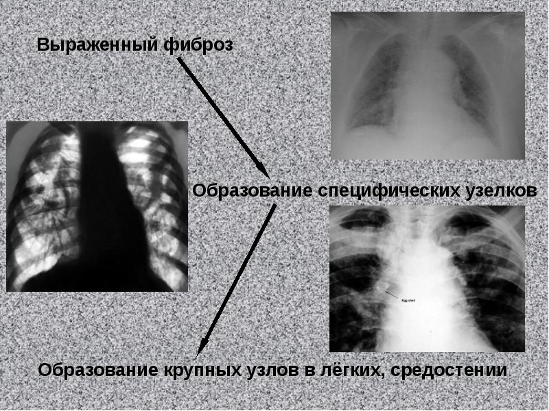 Фиброзные узелки в легких