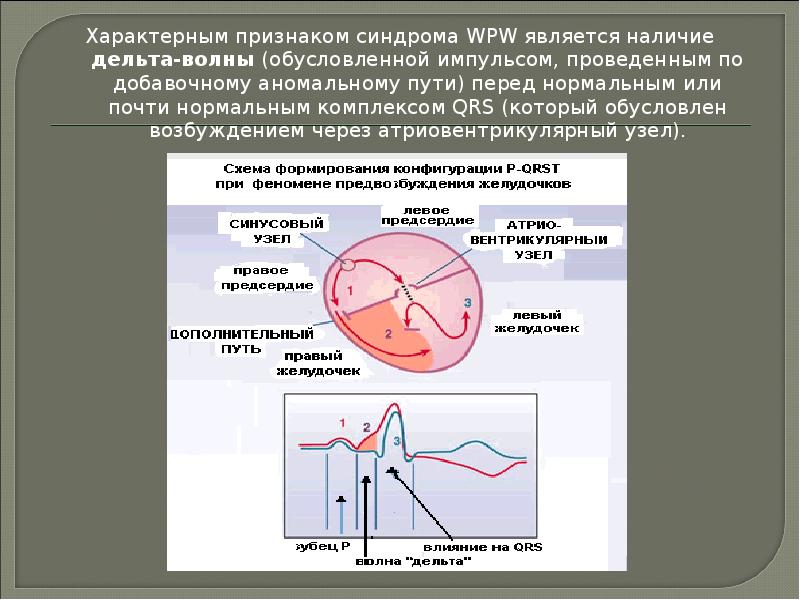 Синдром вольфа паркинсона уайта презентация