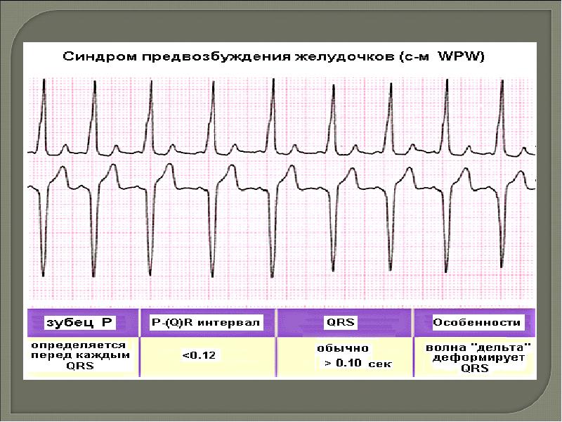 Синдром вольфа паркинсона уайта презентация