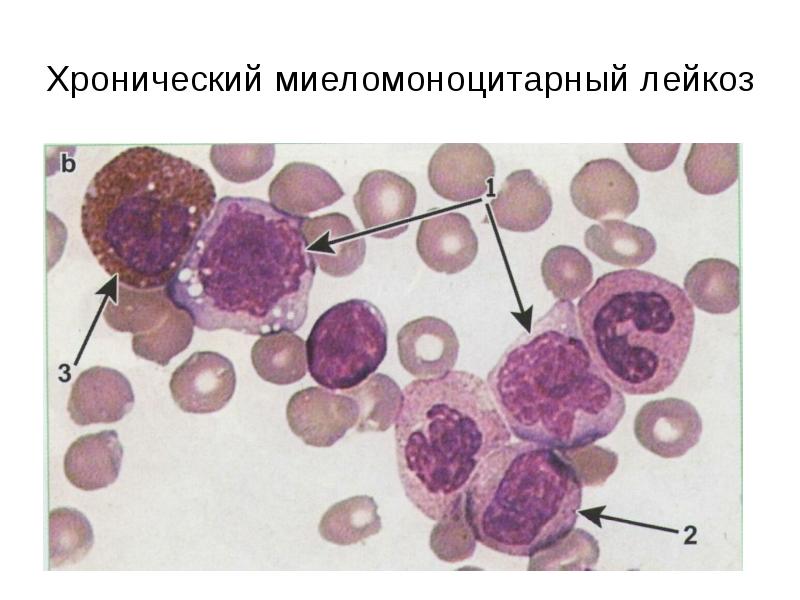 Миеломоноцитарный лейкоз картина крови