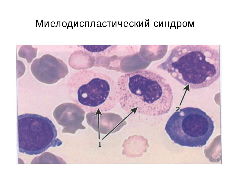 Миелодиспластический синдром презентация