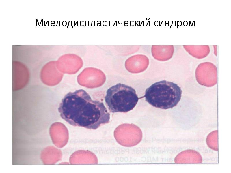 Миелодиспластический синдром презентация