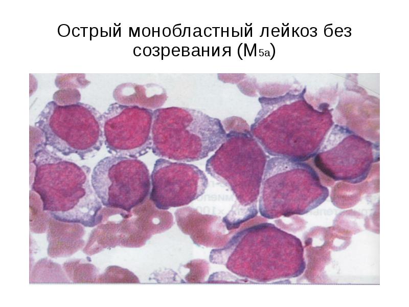 При хроническом моноцитарном лейкозе в картине крови характерен