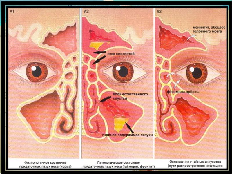Фронтит осложнения. Гайморовы пазухи сфеноидит. Заложенности в пазухах носа. Отек слизистой полости носа.