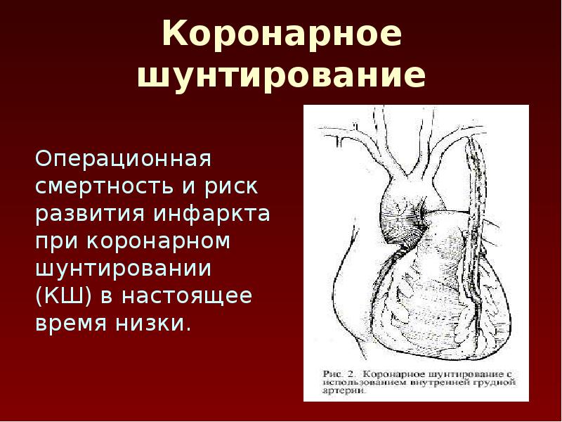 Шунтирование смертность. Коронарное шунтирование. Каронанарное шунтирование. Шунтирование сердца статистика смертности. Коронарное шунтирование процент смертности.