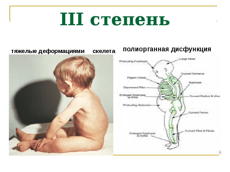 Рахит у детей симптомы. Рахит у детей 1и 2 степени. Рахит у детей по степеням.