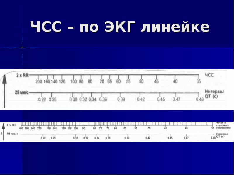 Чсс по экг 25. Чсс по экг 25