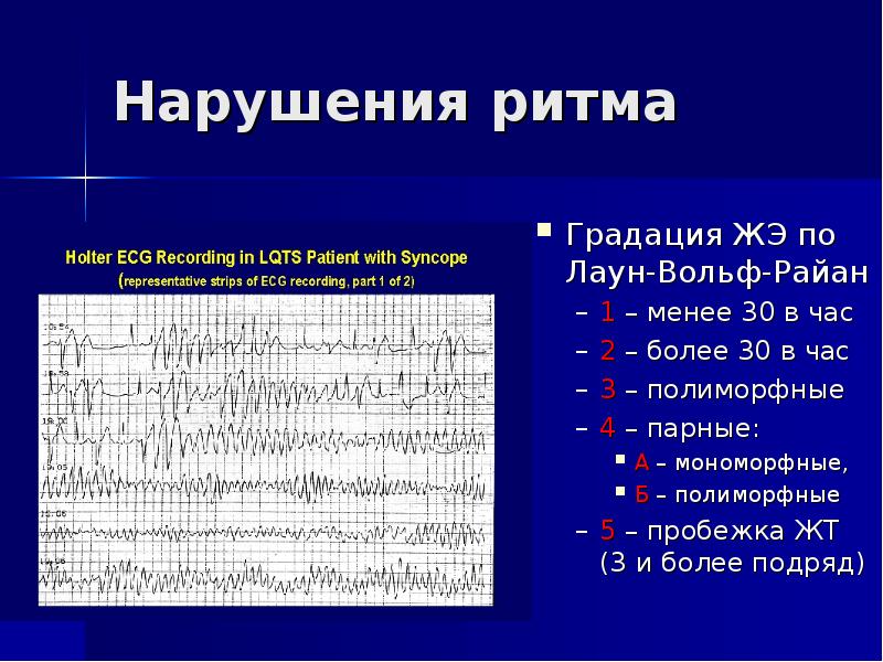 Желудочковая экстрасистолия lown