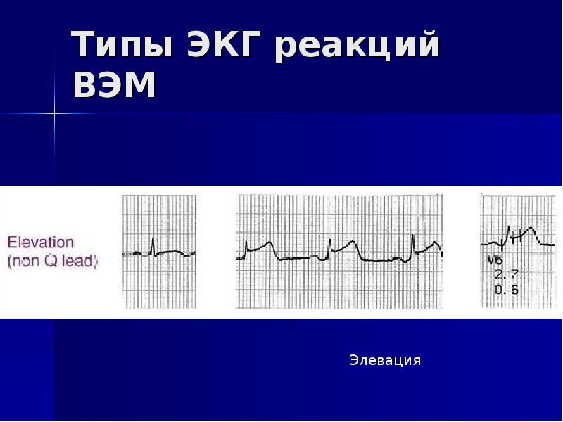S тип экг что это. S тип экг что это. Электрическая ось сердца по зубцу r. S тип экг что это. Правограмма на экг.