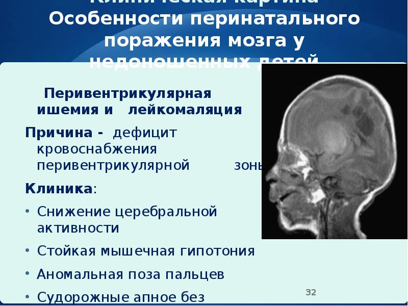 Асфиксия новорожденных презентация