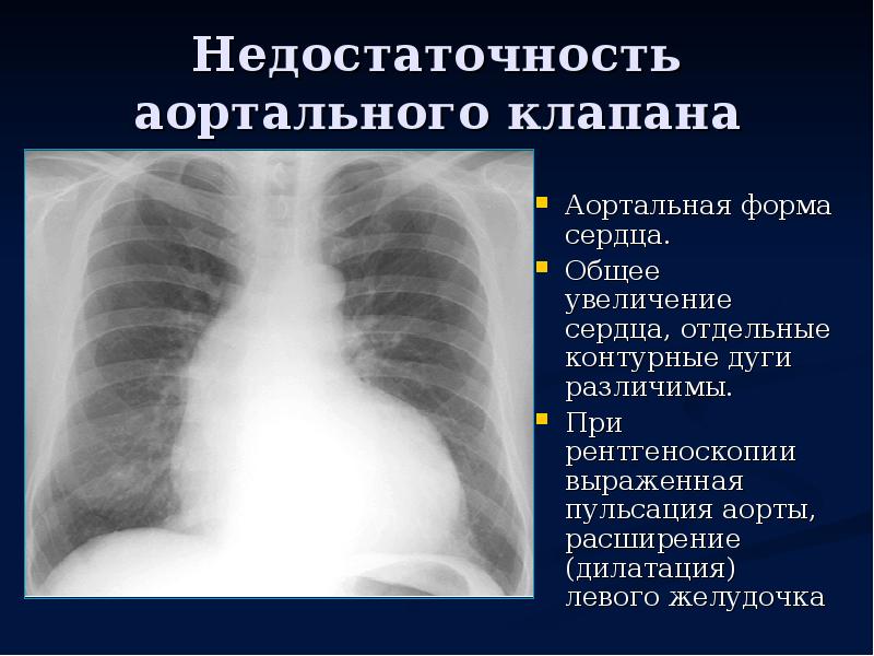 Увеличение сердечной. Увеличено сердце причины. Рентгеноскопия сердца и сосудов. Аорта расширена при флюорографии.