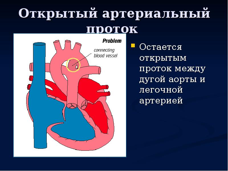 Открываются протоки. Открытый артериальный проток Баталов. Открытый боталлов проток клиника. Боталлов проток у новорожденных. Артериальная связка боталлов проток.