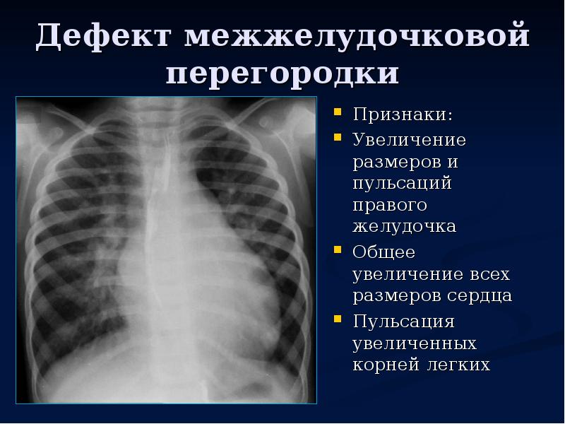 Дефект межжелудочковой перегородки презентация