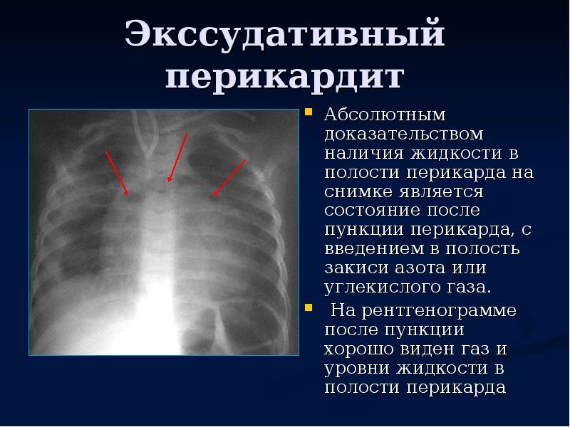 При выпотном перикардите на рентгенограмме наблюдается легочный рисунок тест ответ