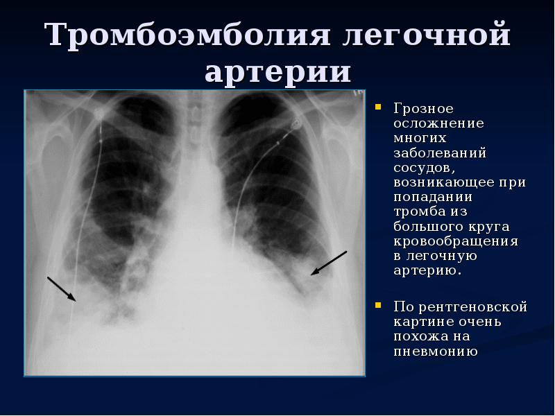 Тромбоэмболия легочной артерии. Тэла пневмония рентген. Инфаркт-пневмония легкого рентген. Тэла инфарктная пневмония. Легочная артерия на рентгенограмме.