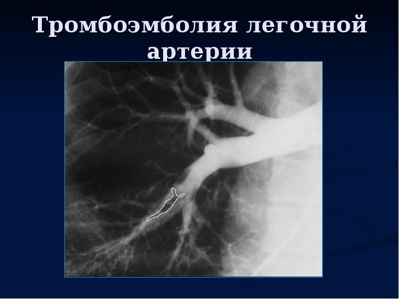 Заболевание тромбоэмболия легочной артерии. Ангиография легочной артерии рентген. Тромбоз ветвей легочной артерии. Тромбоэмболия легочной артерии.