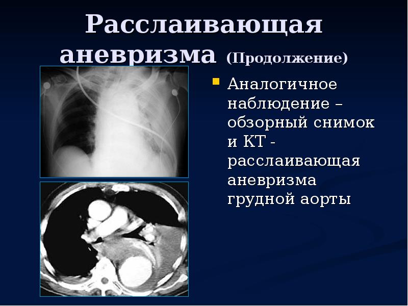 Расслаивающая аневризма карта вызова