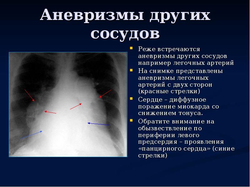 Аневризма сердца. Рентгенодиагностика сердце. Лучевая диагностика сердца. Лучевая анатомия сердца. Аневризма правого предсердия сердца.