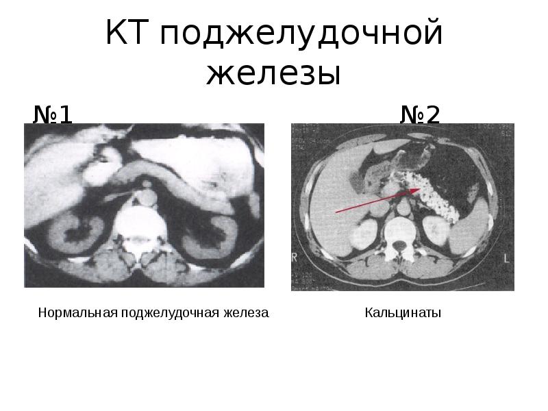 Кт картина панкреатита