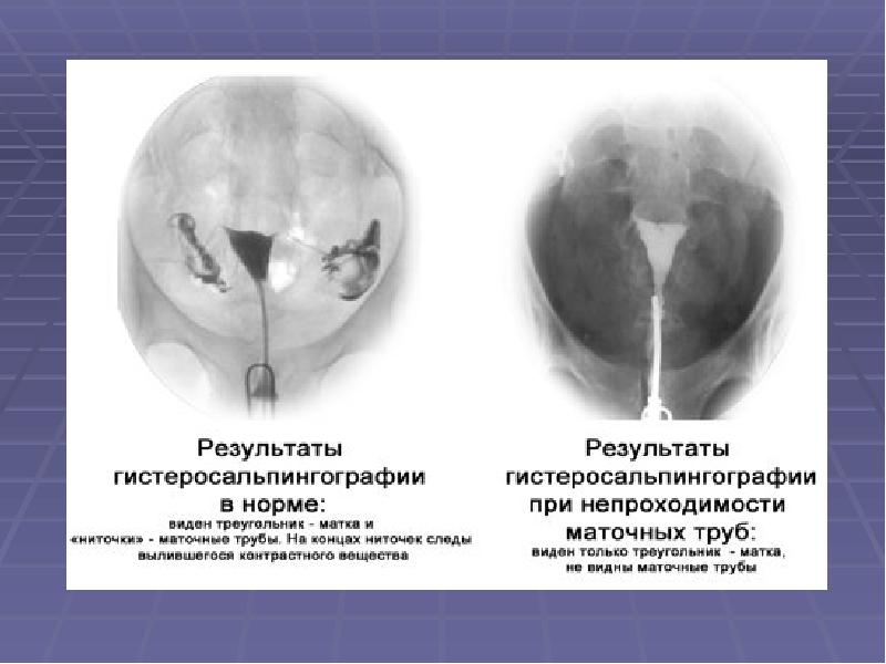 Трубное бесплодие картинки