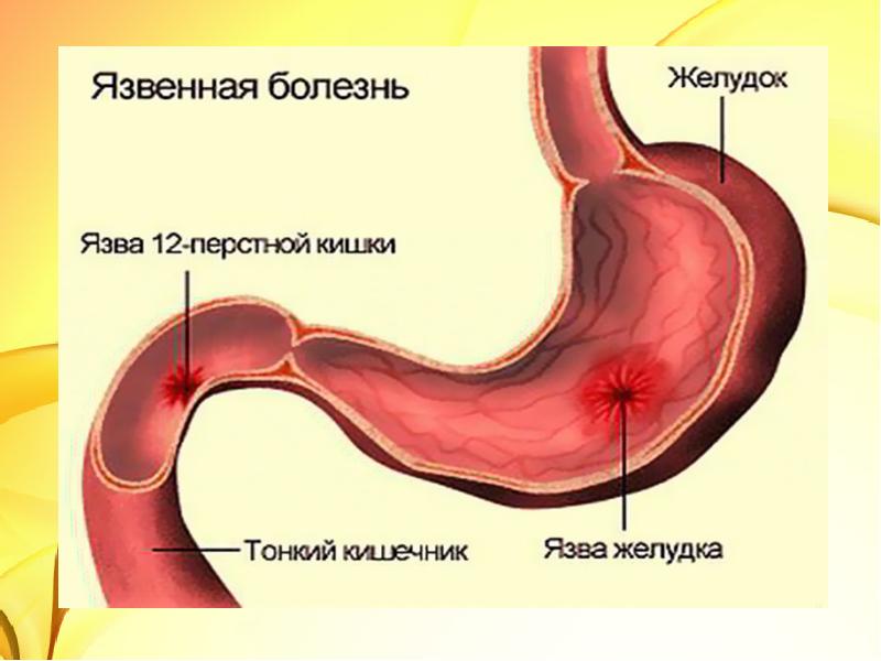 Асқазан обыры презентация