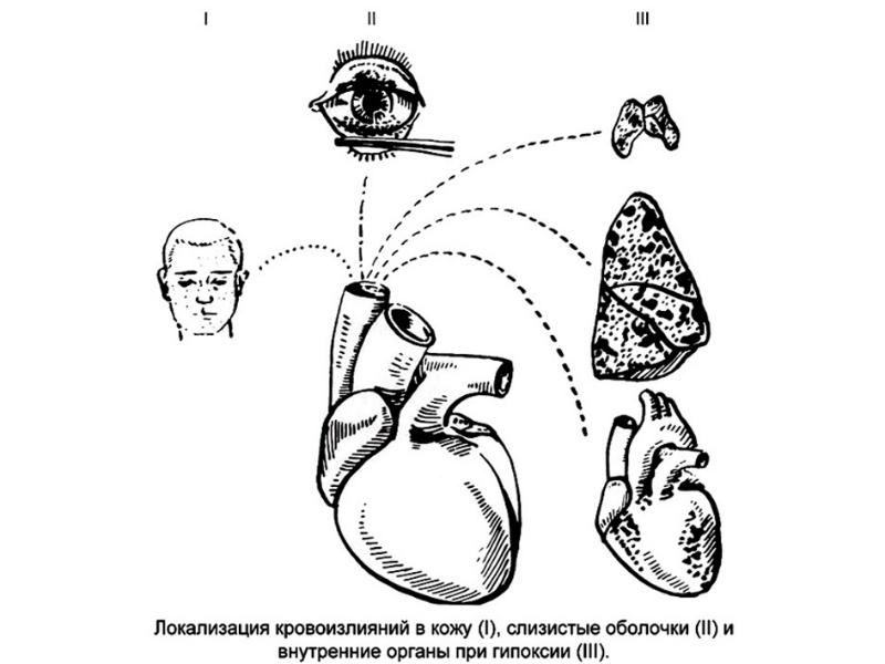 Механическая асфиксия картинки