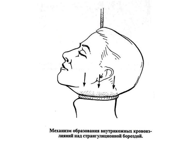 Первая помощь при повешении презентация