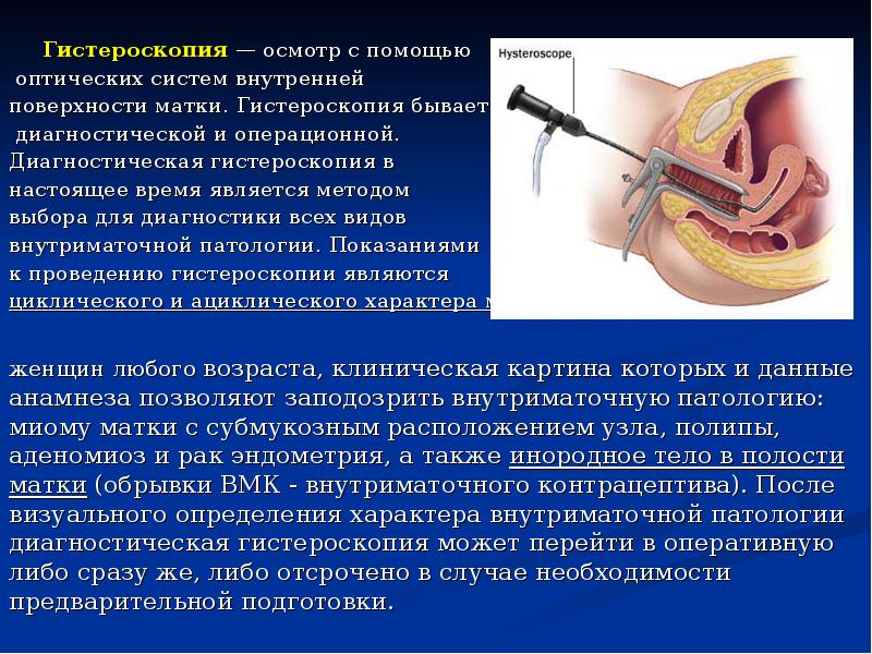 Гистероскопия — осмотр с помощью    Гистероскопия — осмотр