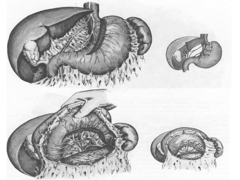 Топографическая анатомия и хирургия. Хирургическая анатомия желудка. Операции на желудке топографическая. Оперативная хирургия желудка. Операции на желудке топографическая анатомия.