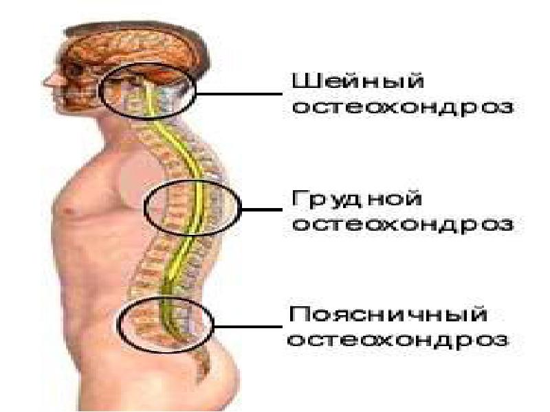 Презентация на тему лечение остеохондроза