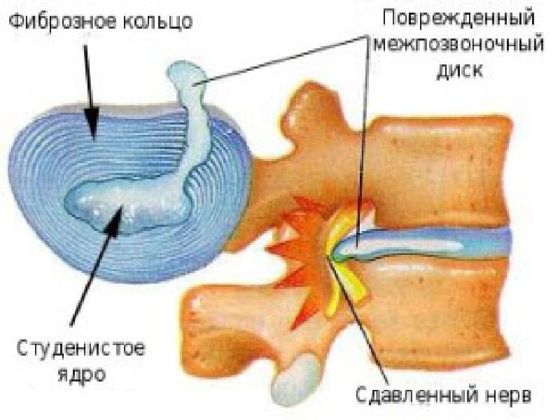 Межпозвоночные диски хрящ